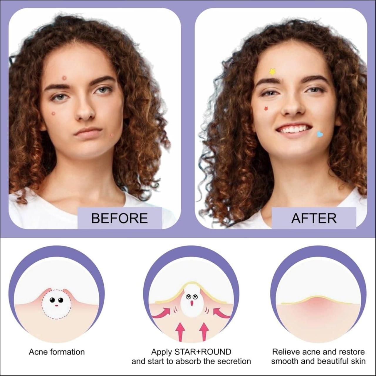 180 Pcs Pimple Patches - Pick Baye