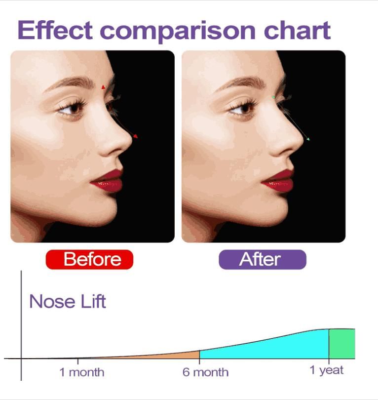 Nose Up Clip - Pick Baye