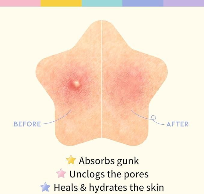 180 Pcs Pimple Patches - Pick Baye