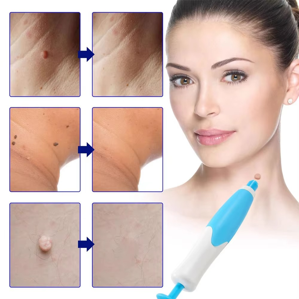 2 in 1 Skin Tag Remover Kit - Pick Baye